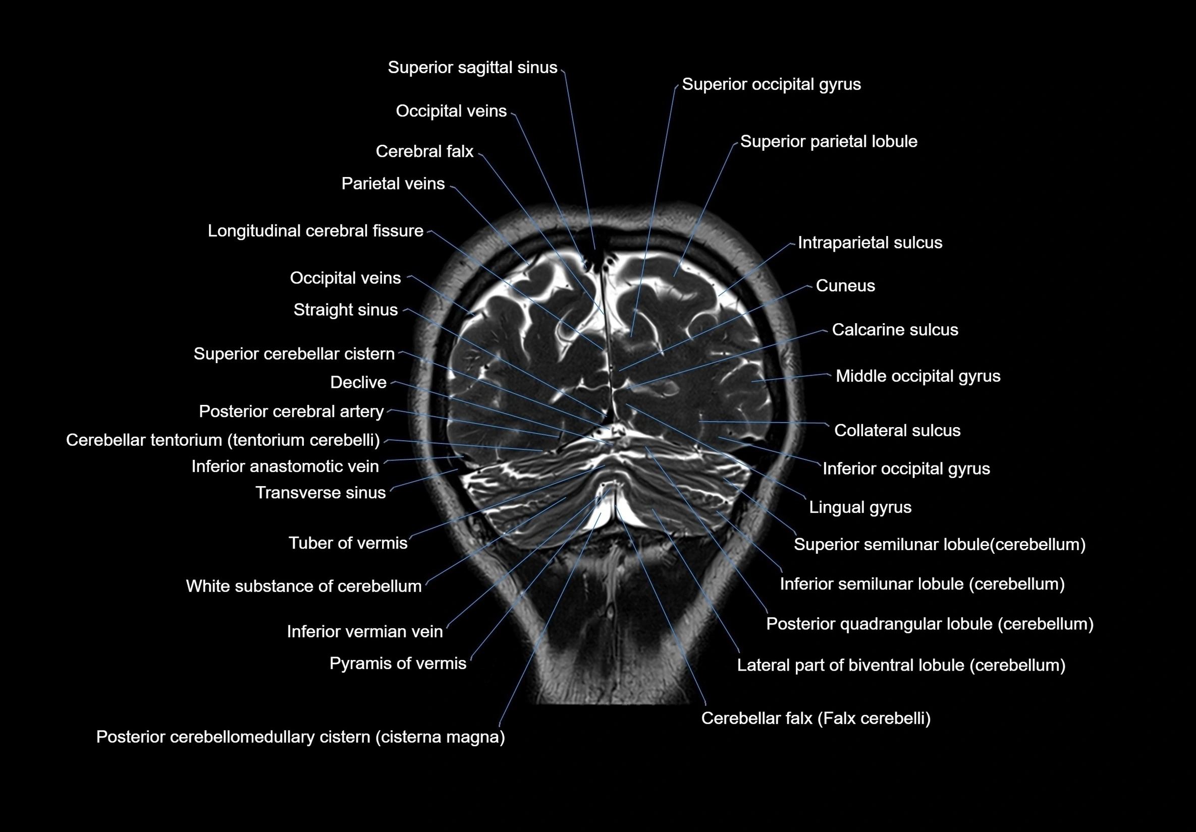 MRI Brain coronal cross sectional labelled anatomy 3T image  -img-00001-00062.webp